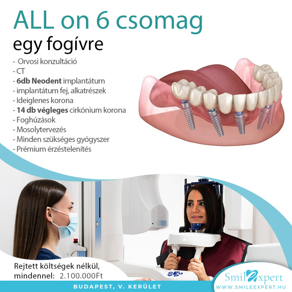 Teljes fels fogsor implant tum ra Smile Expert